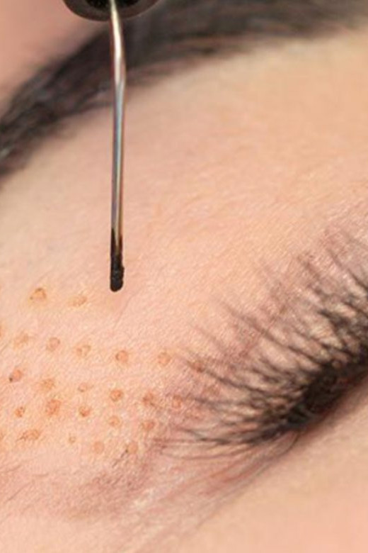 Blefaroplastica medica