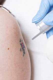 Eliminazione tatuaggi
